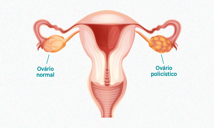 Síndrome dos Ovários Policísticos (SOP) & Fertilidade