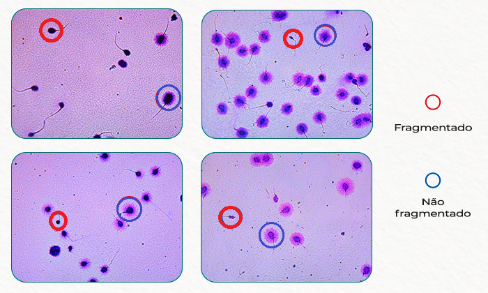 Teste De Fragmentação Do Dna Espermático Feliccita Instituto De