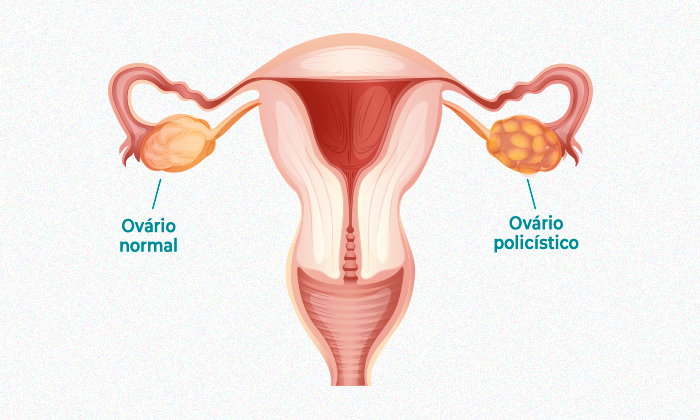 Sop menstruação desregulada